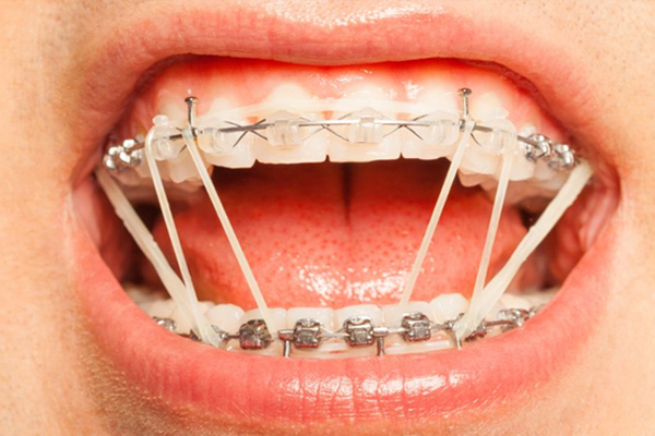 Tại sao khi chỉnh nha lại phải siết chặt răng?