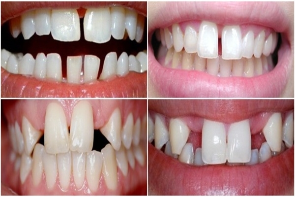 Răng thưa ảnh hưởng gì đến cứ khỏe răng miệng?