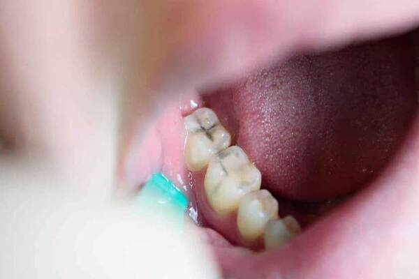 Phương pháp tự trám răng tại nhà là gì?