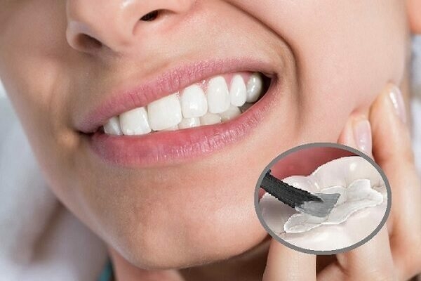 Tự trám răng tại nhà có nguy hiểm không?