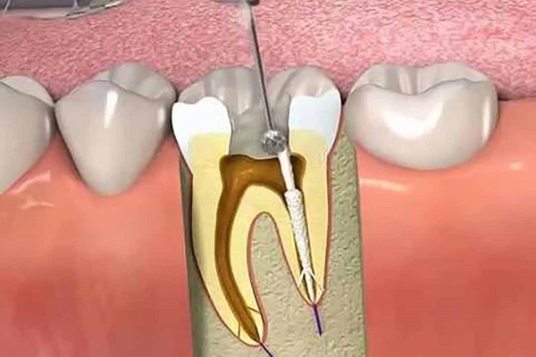 Đặt thuốc diệt tủy răng có đau không?