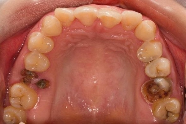 Vấn đề và các bệnh lý liên quan đến răng số 6