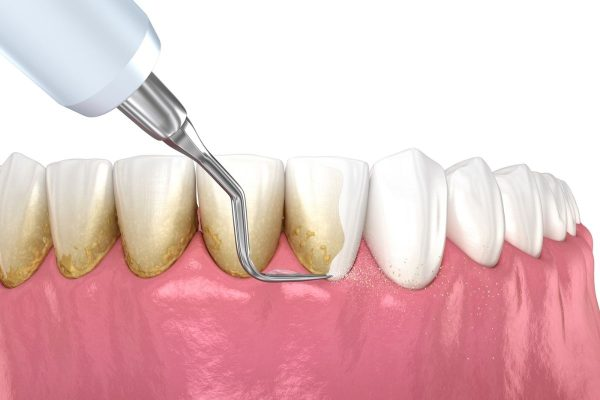 Cao răng là gì?