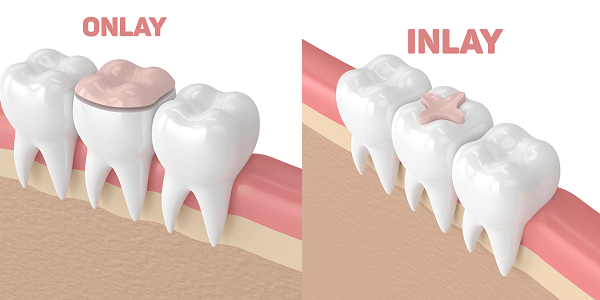 Lấy cao răng gián tiếp (Inlay, Onlay)