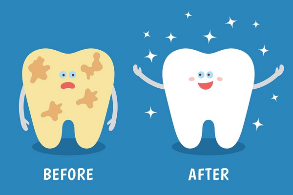 Các lưu ý chăm sóc răng miệng sau khi lấy cao răng