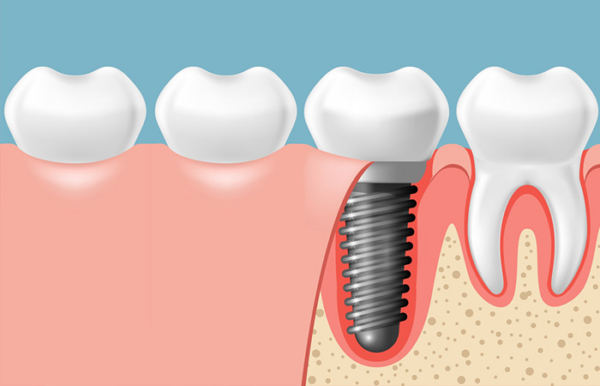 Trồng răng là gì? Mục đích của trồng răng