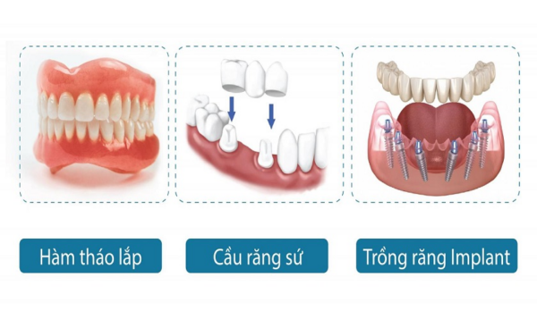 Các phương pháp trồng răng