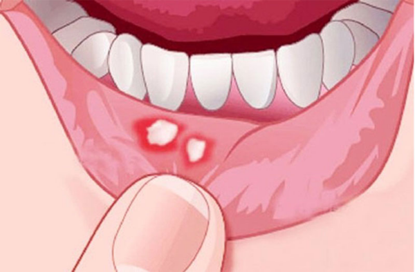 Dấu hiệu và triệu chứng thường gặp khi nhiệt miệng