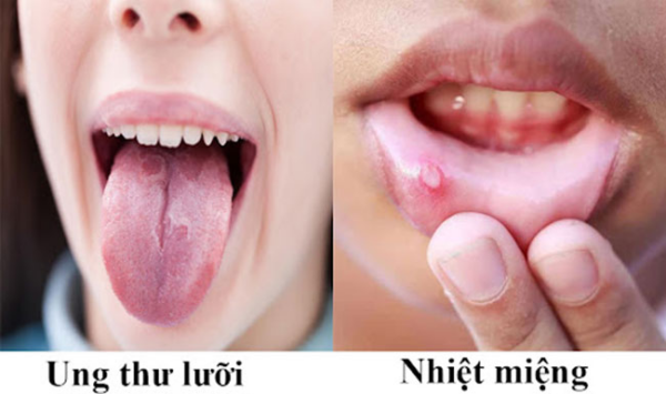 Phân biệt nhiệt miệng và ung thư lưỡi