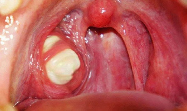 Răng mọc trong vòm miệng là gì?