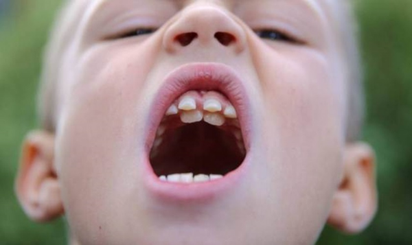 Nguyên nhân gây ra tình trạng răng mọc trên vòm miệng