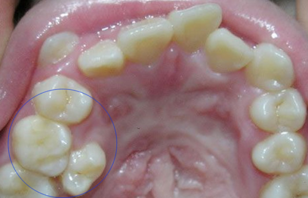 Gây ảnh hưởng đến các răng xung quanh