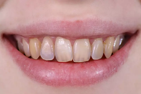 Răng bị nhiễm màu