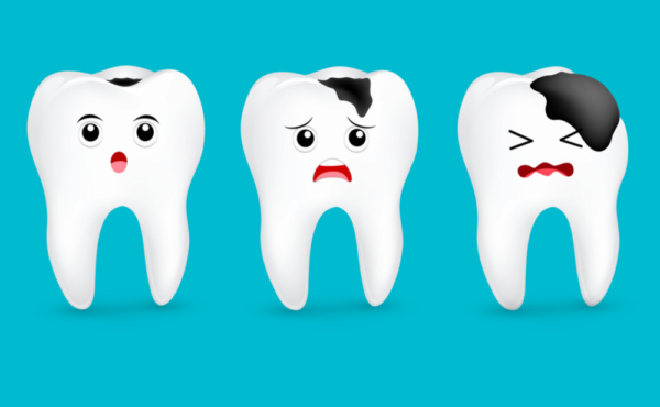 Do răng tiếp xúc nhiều với thức ăn, người bị cười hở lợi thường có nguy cơ mắc các bệnh về răng