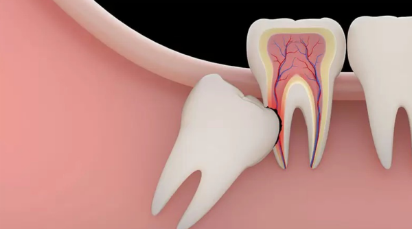 Răng khôn mọc lệch 45 độ do nguyên nhân gì