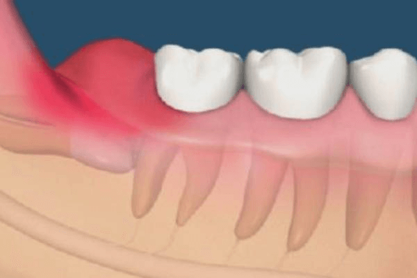 Khi răng khôn mọc lệch vùng nướu xung quanh răng bị viêm nhiễm, sưng đỏ