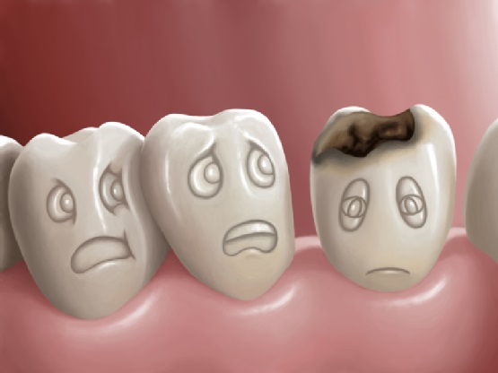 Để sâu răng kéo dài sẽ khiến răng dễ gãy hơn