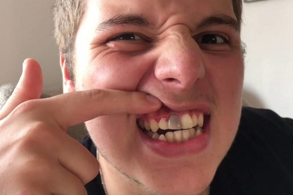 Triệu chứng của gãy răng cửa là gì?