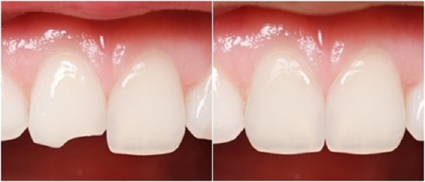 phương pháp phục hình bằng composite hay sứ để khôi phục lại hình dạng ban đầu của răng