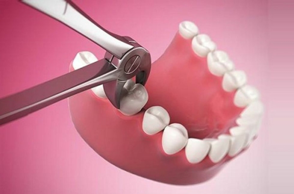 Những yếu tố nào là ảnh hưởng trực tiếp đến thời gian phục hồi sau khi nhổ răng khôn?