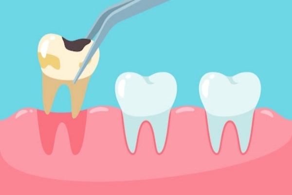 Việc lựa chọn kỹ thuật và ứng dụng công nghệ phù hợp chính là chìa khóa giúp tăng tốc quá trình phục hồi sau nhổ răng