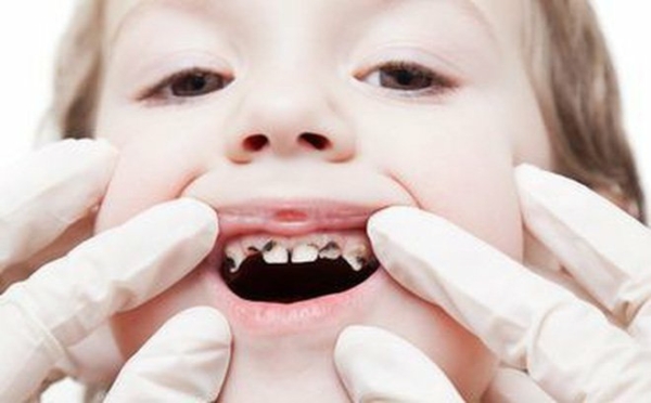 Các trường hợp nên niềng răng cho trẻ 10 tuổi