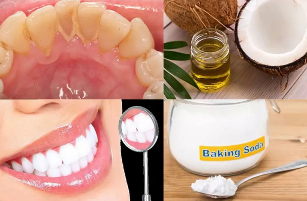 Kết hợp dầu dừa với muối sẽ giúp lấy sạch cao răng triệt để