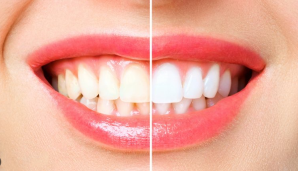 Khi áp dụng các cách dùng muối lấy cao răng tại nhà, bạn cần tuân thủ những lưu ý trên để đảm bảo an toàn cho răng miệng