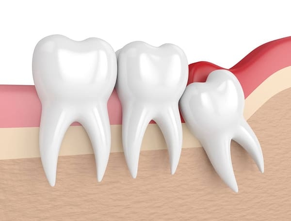 Nhổ răng khôn có ảnh hưởng gì đến răng miệng không?