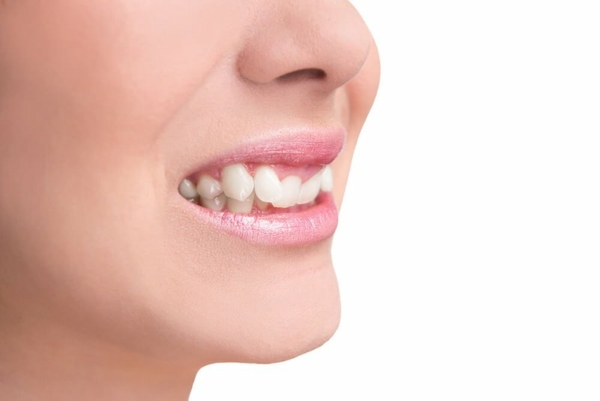 Đánh lún răng sẽ giúp khắc phục triệt để tình trạng răng bị vẩu hoặc hô