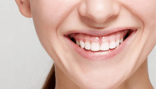 Đánh lún răng cửa là phương pháp đơn giản, hiệu quả để khắc phục tình trạng cười hở lợi
