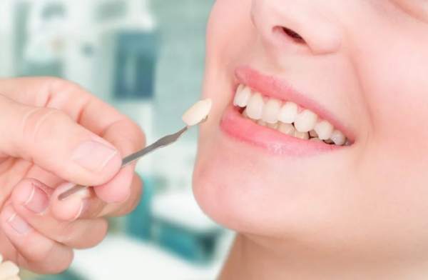 Bọc sứ là lựa chọn tối ưu để điều trị răng nhiễm tetracycline triệt để và lâu dài