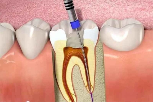 Lấy tủy răng là quá trình loại bỏ phần tủy bên trong răng bị viêm nhiễm hoặc hoại tử