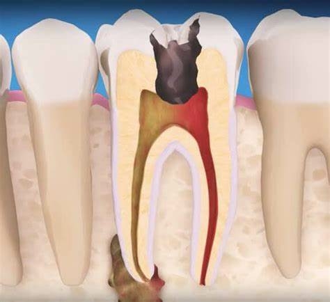 Những trường hợp nào thường cần phải lấy tủy răng?