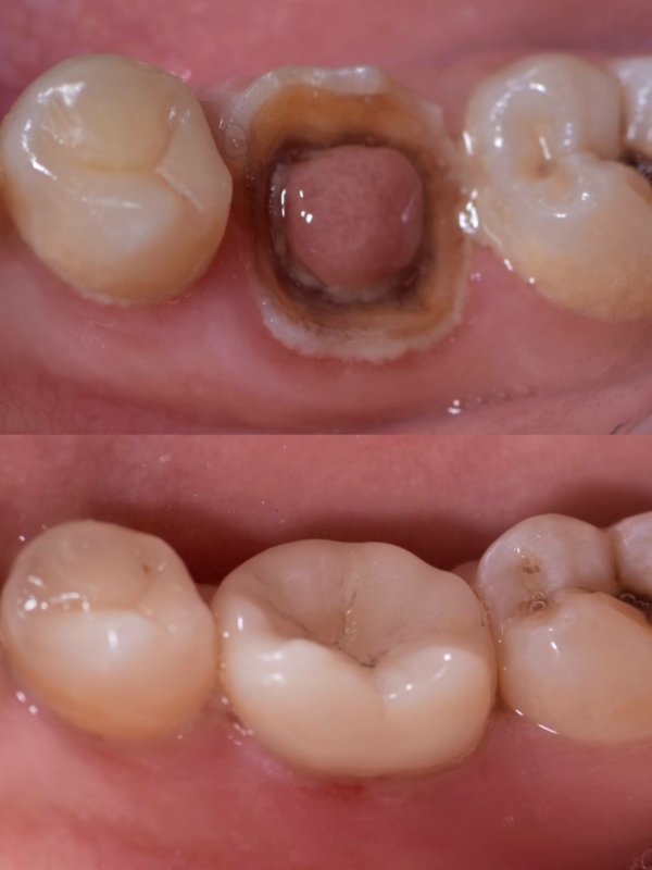Endocrown có thể phục hồi thẩm mỹ răng gần như hoàn hảo