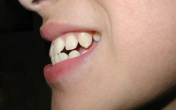 Tật đẩy lưỡi kéo dài sẽ gây ra các tác động xấu và hậu quả nghiêm trọng cho răng miệng