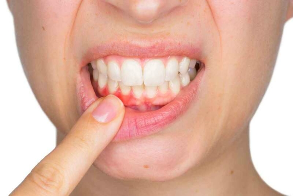 Do nướu bị viêm nhiễm, người bị tụt lợi thường gặp tình trạng chảy máu nhẹ khi đánh răng