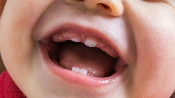 Phanh môi bám thấp ở trẻ sơ sinh