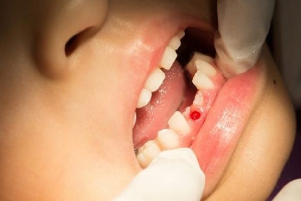 Nguyên nhân gây ra tình trạng nhổ răng còn sót chân răng