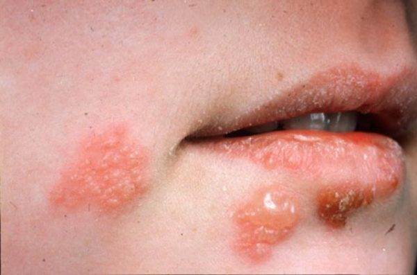 Mụn nước do nhiễm virus Herpes simplex