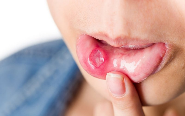 Viêm loét miệng ở trẻ em là bệnh gì?