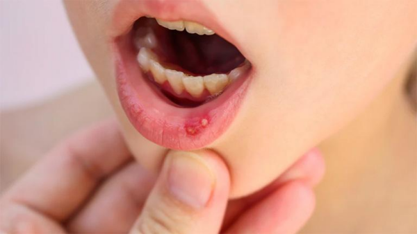 Dấu hiệu nhận biết viêm loét miệng ở trẻ nhỏ