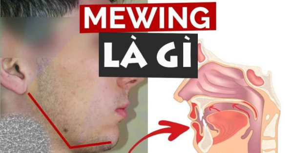 Tìm hiểu về Mewing - cách đặt lưỡi đúng cách
