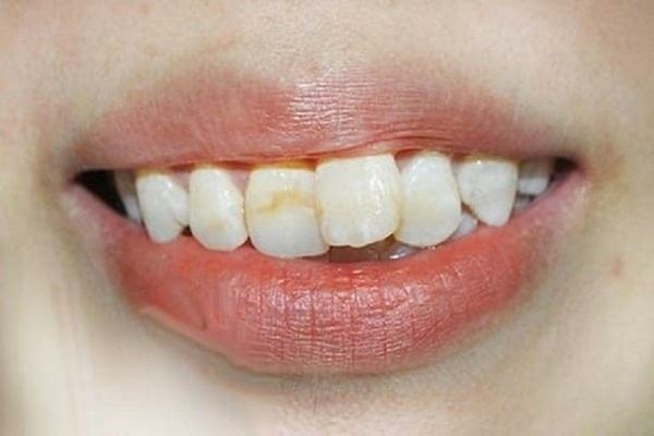 Răng cửa mọc lệch là như thế nào?