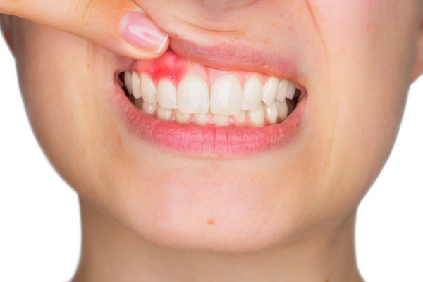 Dấu hiệu đầu tiên của viêm nha chu thường là sưng và đau nổi ở vùng răng chân răng