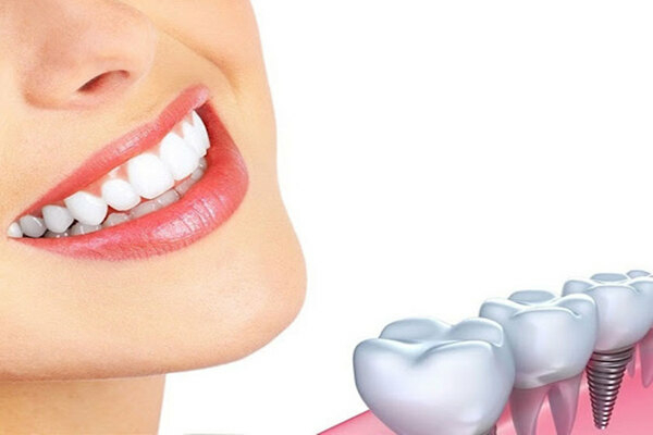 Ưu điểm và nhược điểm của trồng răng implant