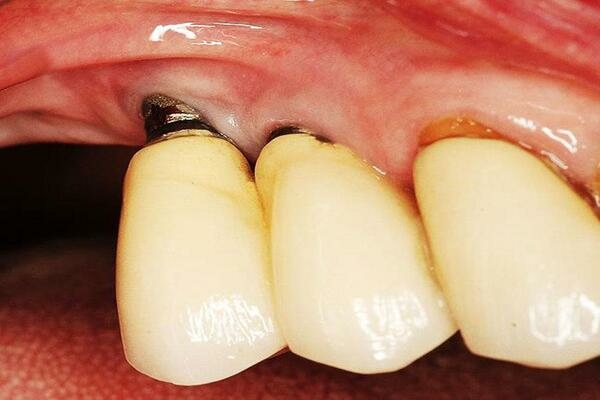 Các rủi ro khi cấy ghép răng Implant