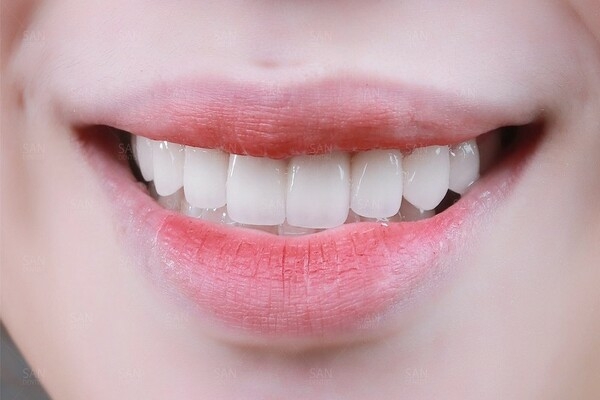 Răng đều như hạt bắp la như thế nào?
