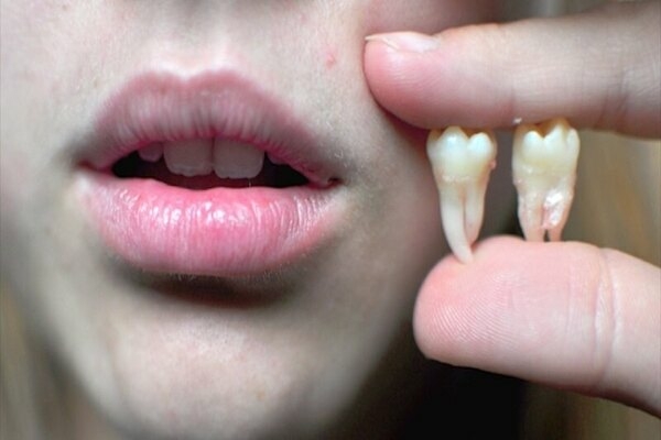 Răng khôn sau khi nhổ có mọc lại được không?