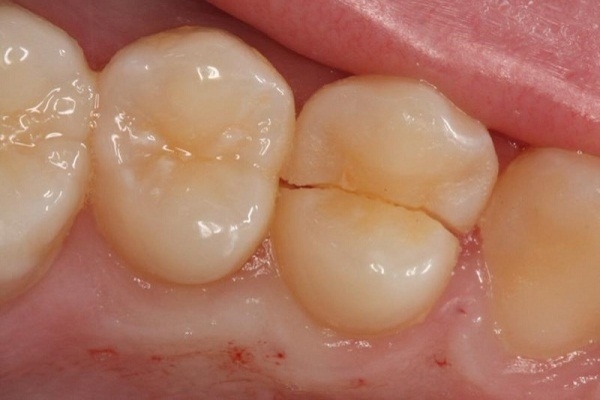 Nguyên nhân gây nứt răng